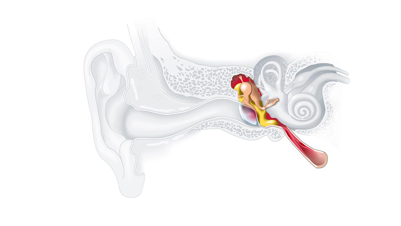 Ear Infections in Children